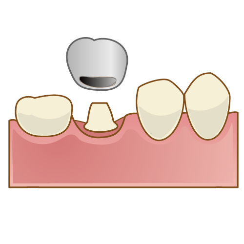 セラミッククラウン2種類について