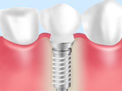 インプラントとは